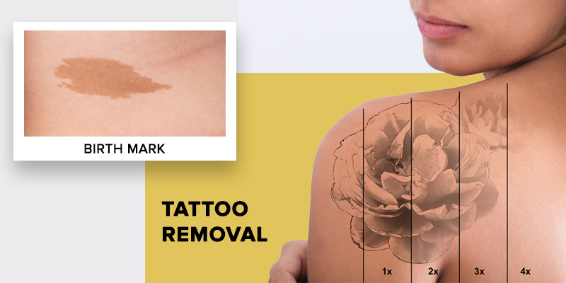 Birth mark and tattoo removal