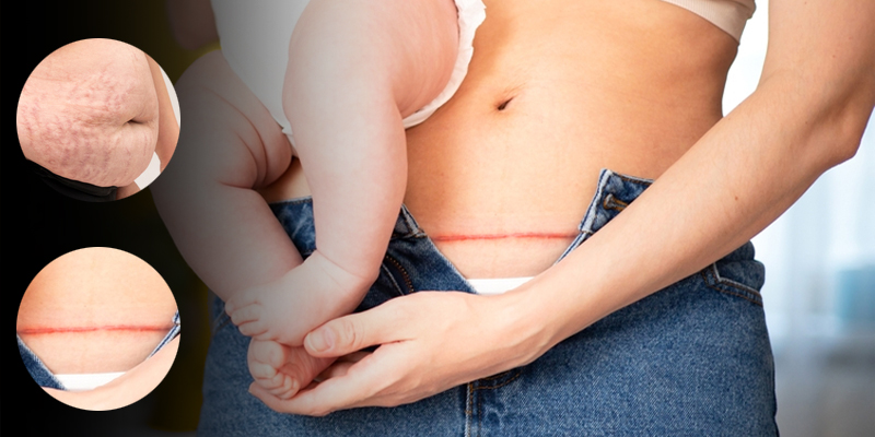 Potential Risks of Tummy Tuck Surgery Post Pregnancy?