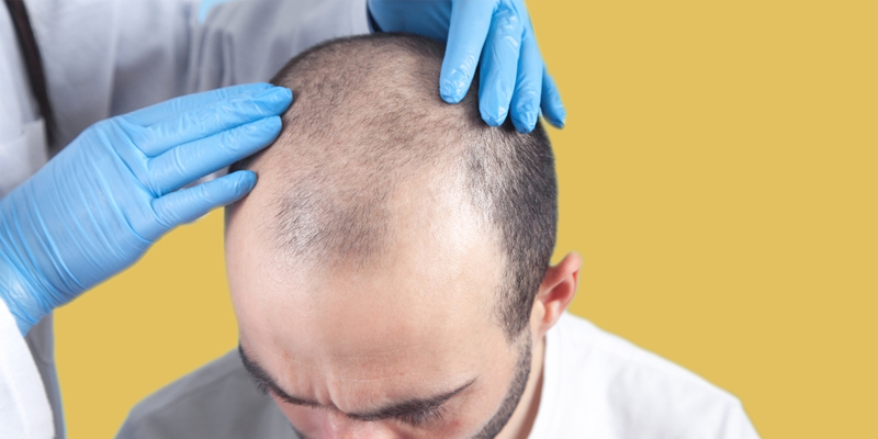 Does Hair Transplant gets affected by Summer Sweat?