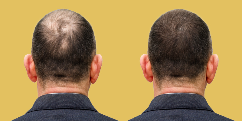 Hair Transplant Miracle: Transform Your Look with Orange Tree
