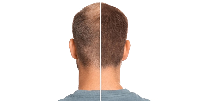 How much does a hair transplant cost in Delhi?