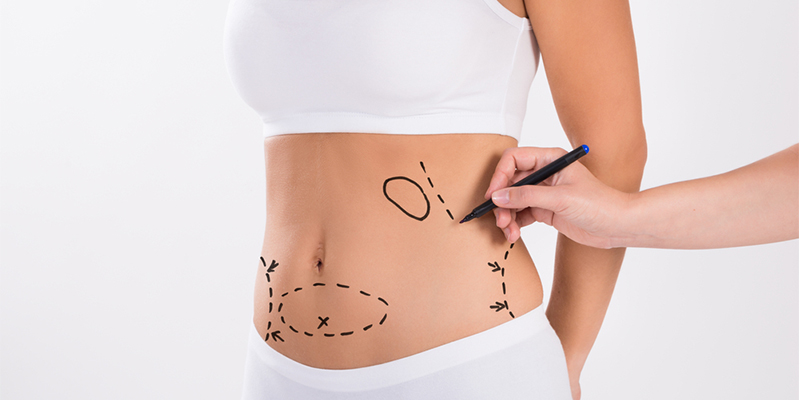 How Much Would It Cost to Get Liposuction?