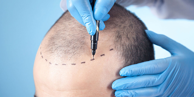 How to Identify a Reputable Hair Transplant Doctor?