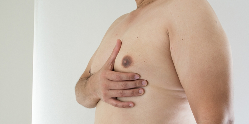 How Can You Reduce Gynecomastia Naturally Without Surgery?