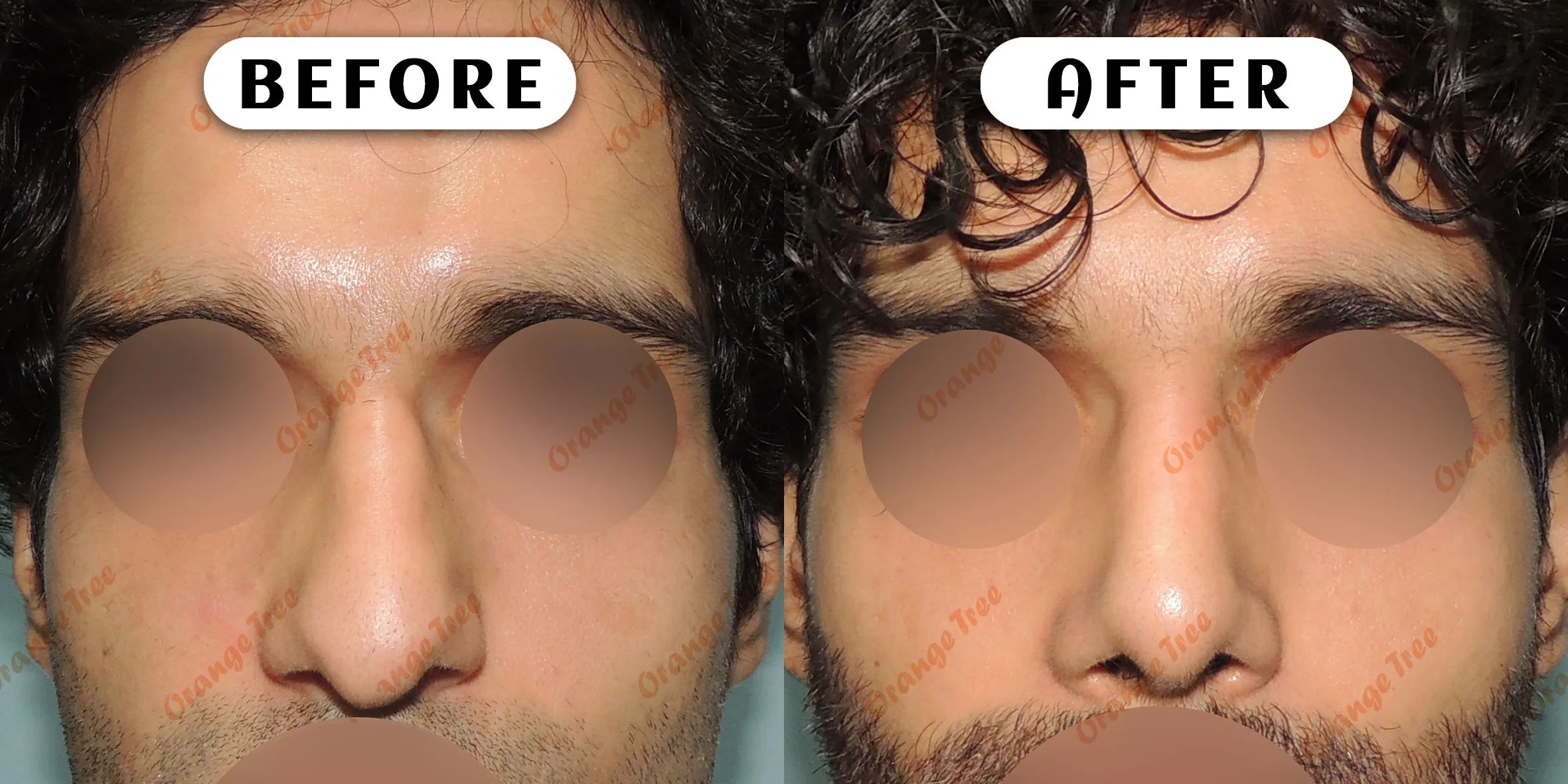 Rhinoplasty